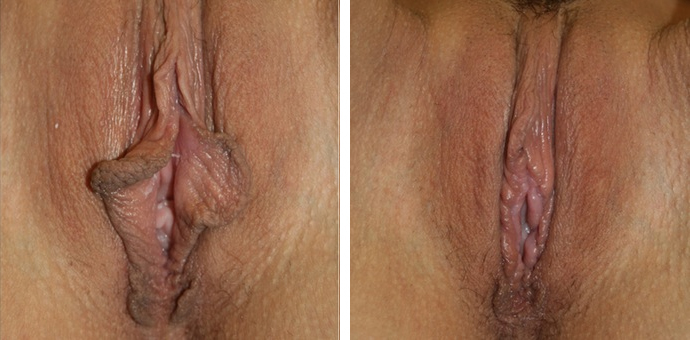 Labiaplasty Minora
