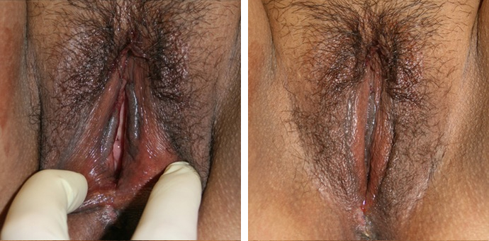 Vaginoplasty