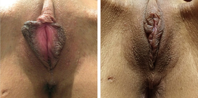 Labiaplasty Minora