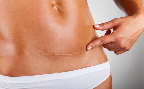 C-Section-Scar-Reduction