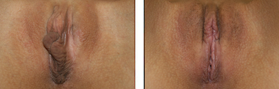Labiaplasty