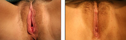 Vaginoplasty & Labiaplasty