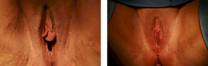 Vaginoplasty & Labiaplasty