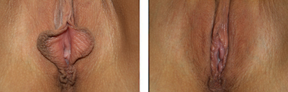 Labiaplasty