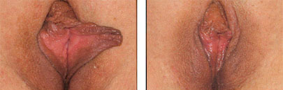 Labiaplasty