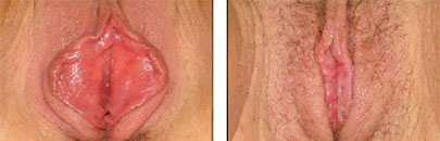 Labiaplasty