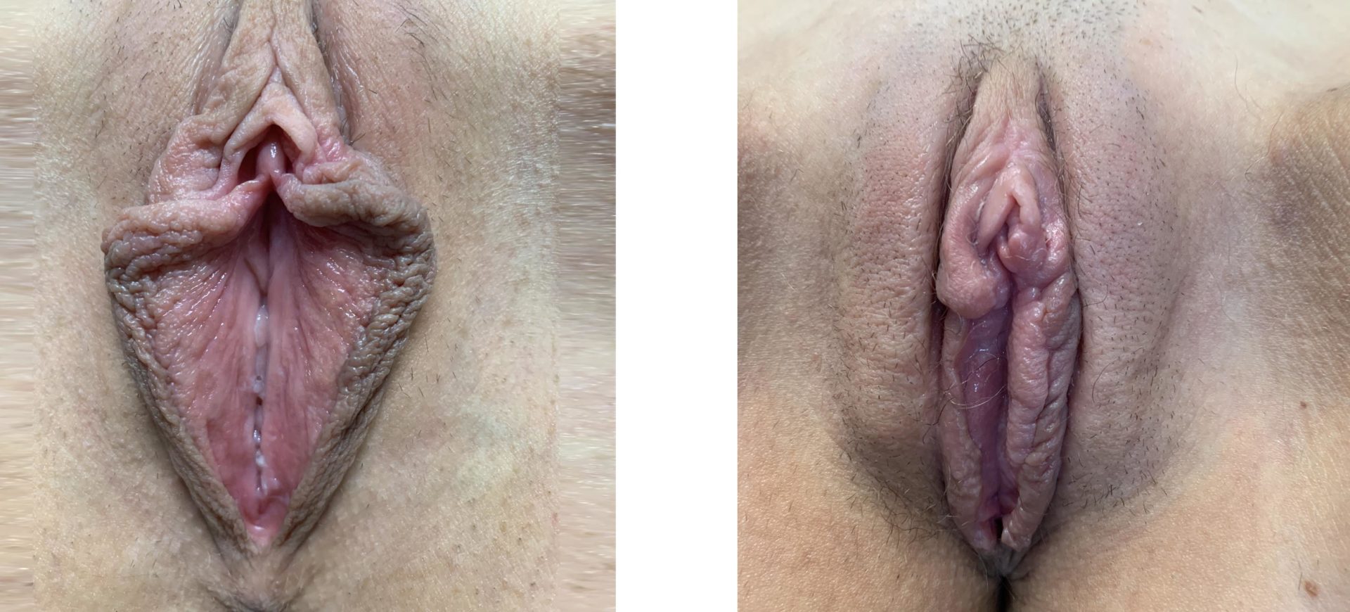 Labiaplasty Minora