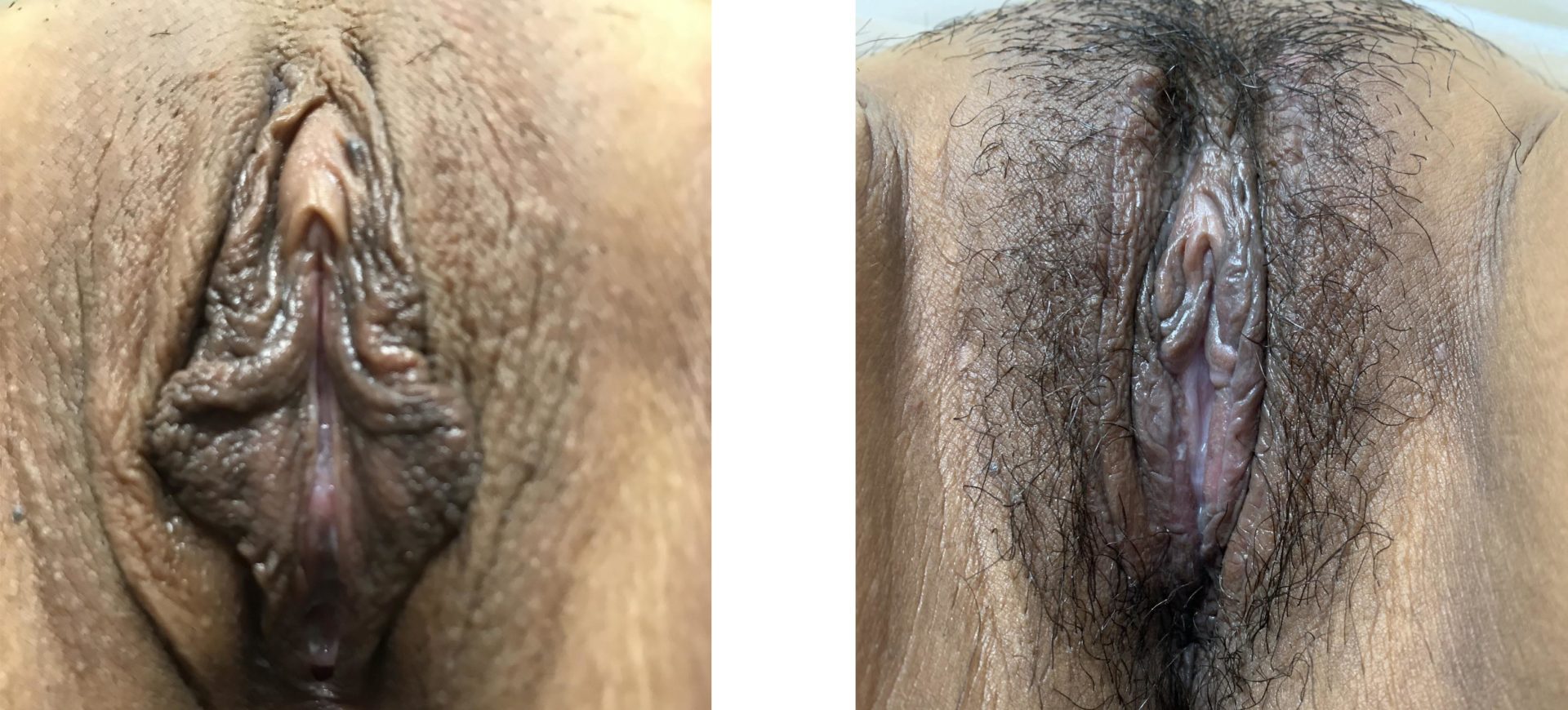 Labiaplasty minora and majora