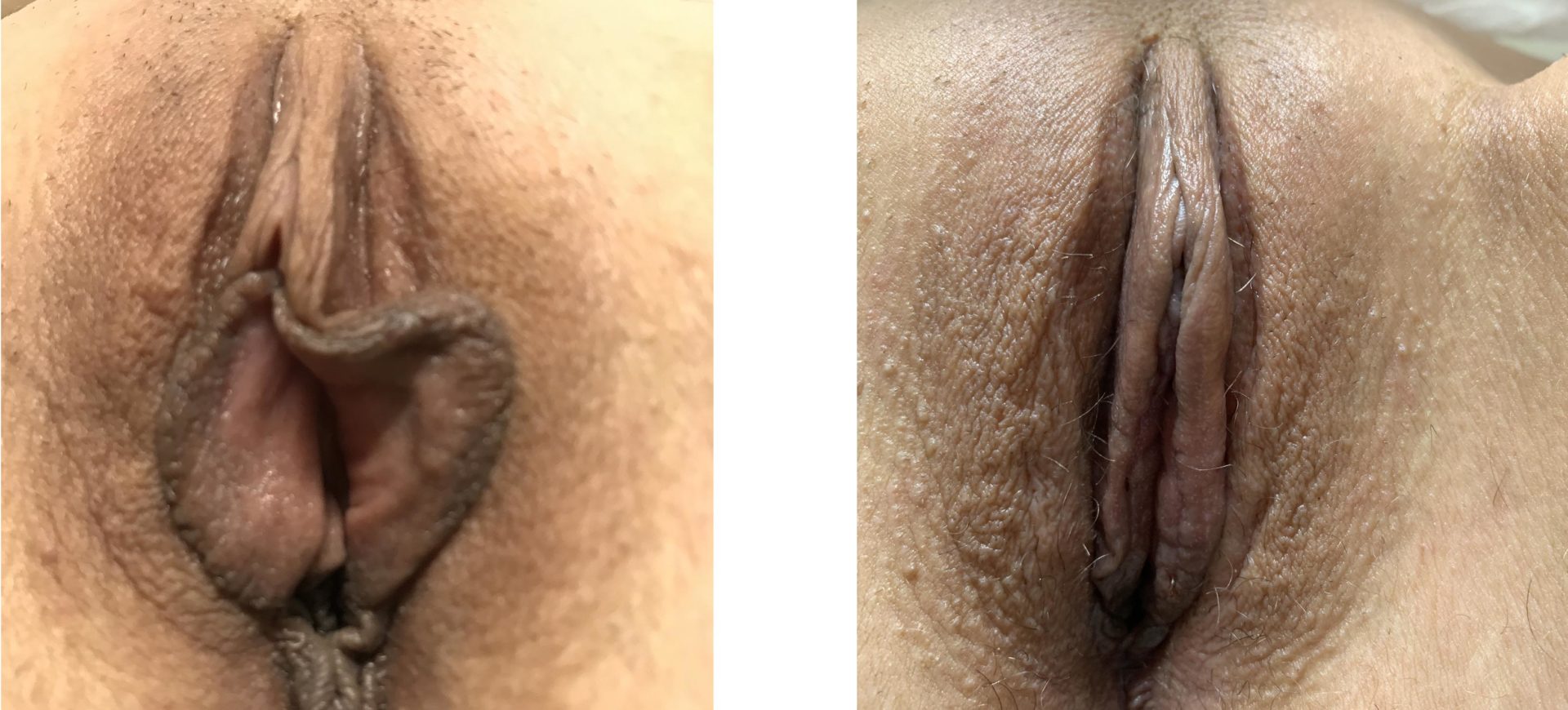 Labiaplasty Minora